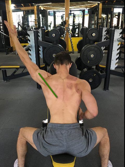 impingement
